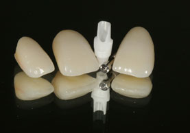 CROWNS FOR TWO NATURAL TEETH AND ONE IMPLANT ABUTMENT