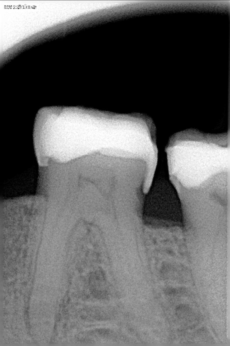 PATIENT WAS HAVING PAIN WHEN SHE CHEW FOOD,GERMAN DENTIST JUST FILLED THE TOOTH 