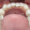 Immediate implants with permanent crowns
