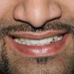 Missing teeth replaced with immediate loading dental implants
