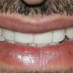 Replaced missing teeth with dental implants & permanent crowns