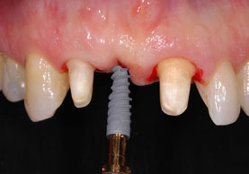 PLACEMENT OF NOBEL ACTIVE AFTER REMOVAL OF BRIDGE