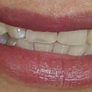 REMOVED DECEDIOUS REPLACED WITH IMMEDIATE IMPLANTS AND PERMANENT CROWNS