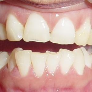 BOTH CANINE TEETH ARE DECEDIOUS (MILK TEETH)